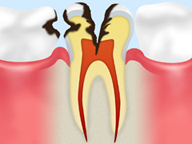 重度の虫歯・歯折の場合