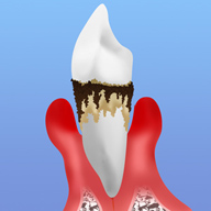 歯周病が進行した場合